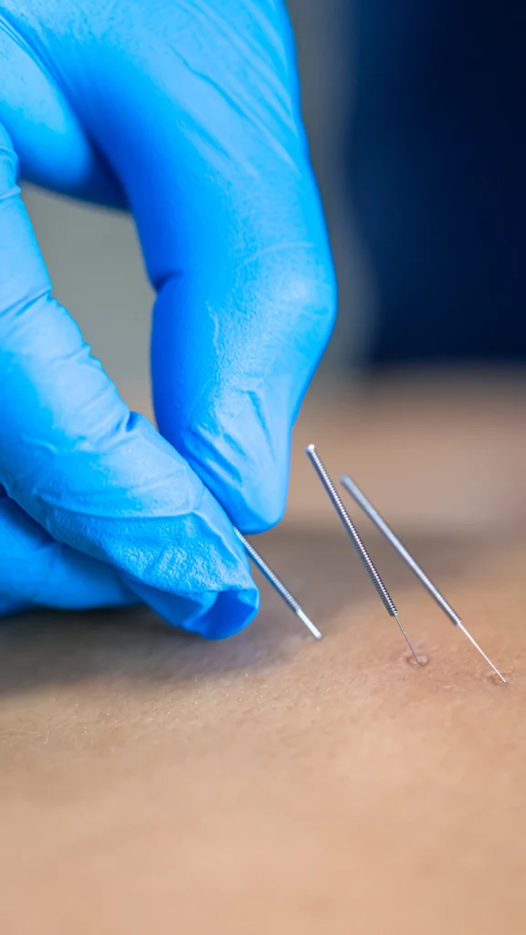 acupuncture in basingstoke